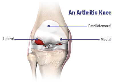 Arthritic Knee