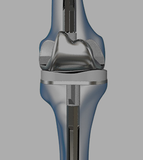 Robotic Patellofemoral Replacement