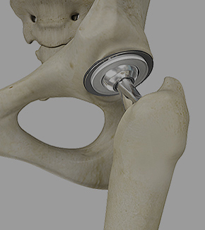 Robotic Total Hip Replacement