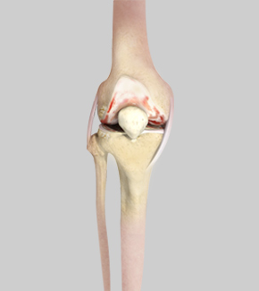 Triathlon Knee Replacement